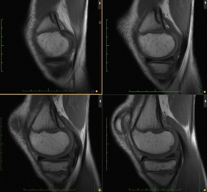 Figure 2 for case Cortical desmoid